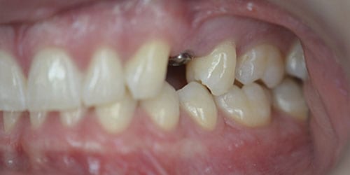 Back Teeth Matter - Example 1 - Before