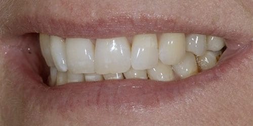 Back Teeth Matter - Example 2 - After