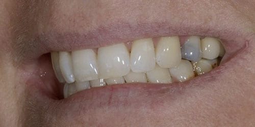 Back Teeth Matter - Example 2 - Before