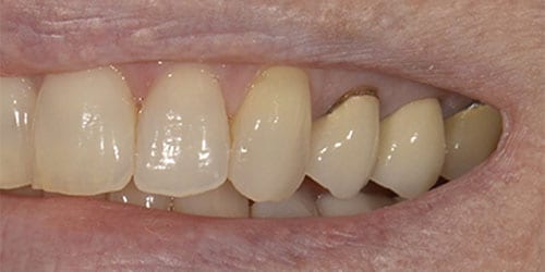 Back Teeth Matter - Example 3 - Before