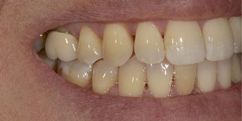Back Teeth Matter - Example 4 - Before