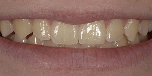 Kor Tooth Whitening - Example 3 - Before