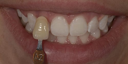 Kor ToothWhitening - Example 3 - After