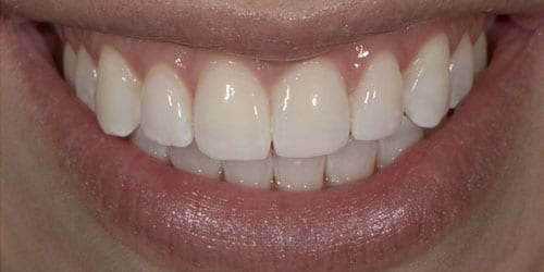 Kor ToothWhitening - Example 5 - After
