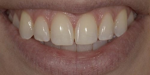 Kor ToothWhitening - Example 5 - Before