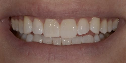 Kor ToothWhitening - Example 6 - After