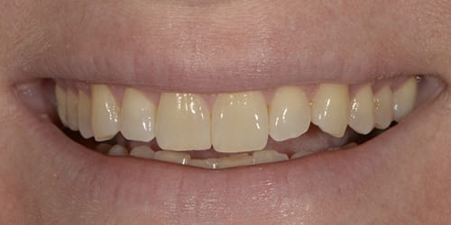 Kor ToothWhitening - Example 6 - Before