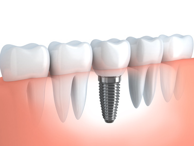 Dentals Implants