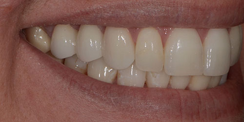 Tooth Replacement - Bridge Dentistry 1 - After