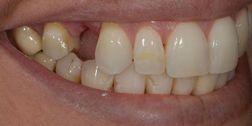 Tooth Replacement - Bridge Dentistry 1 - Before