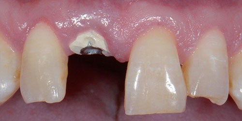 Tooth Replacement - Implant Dentistry 1 - Before