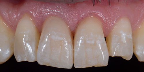 Old Ugly Dentistry - Implant Dentistry - After
