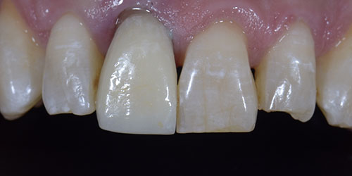 Old Ugly Dentistry - Implant Dentistry - Before