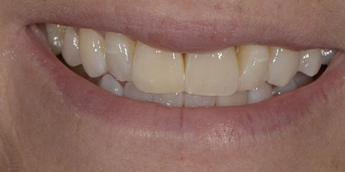 Tooth Replacement - Maryland Bridge 1 - After