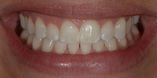 Kor ToothWhitening - Example 11 - After
