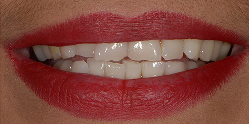 Smile Makeover - Michelle - Before