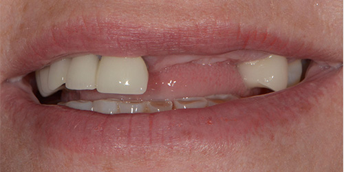 Tooth Replacement - Shannon - Before